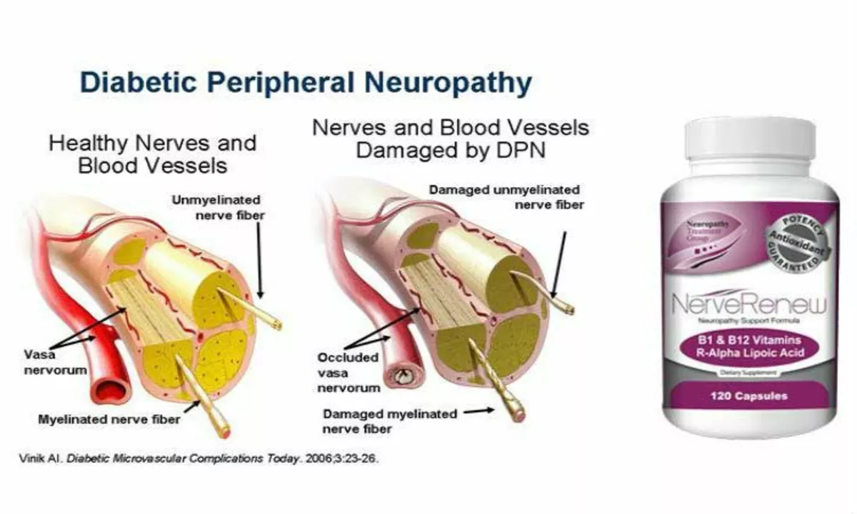 The Connection Between Diabetic Peripheral Neuropathy and Kidney Disease