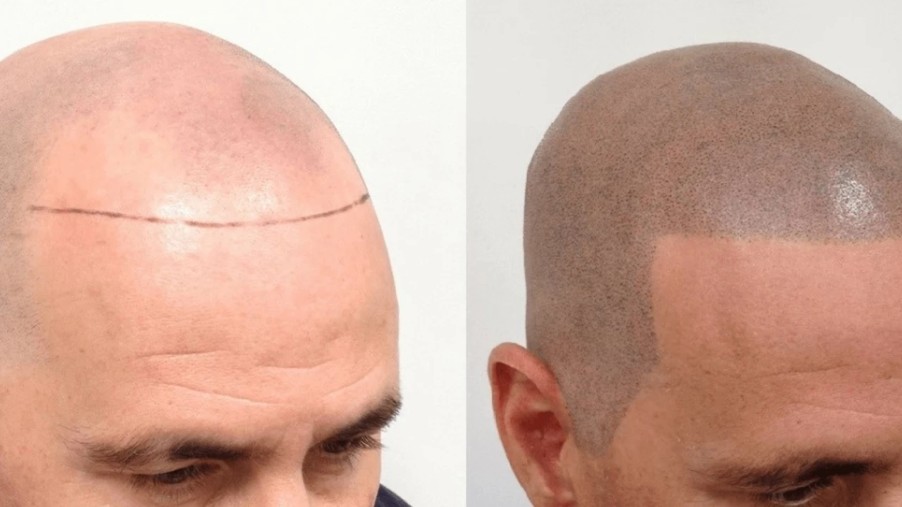 Androgenic Alopecia and Scalp Micropigmentation: A Lasting Solution for Hair Loss